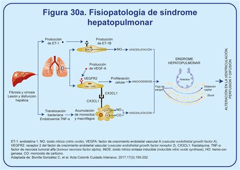 Diagrama de la fisiopatología del síndrome hepatopulmonar