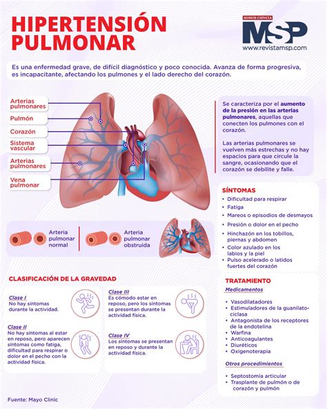 Representación esquemática de la circulación pulmonar en la hipertensión portopulmonar