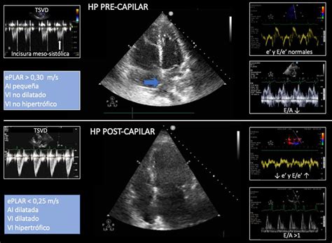 Ecocardiograma mostrando signos de hipertensión pulmonar