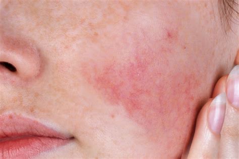 Piel sensible con rojeces