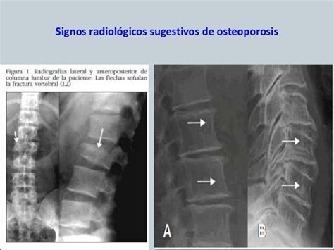 Radiografía de huesos mostrando signos de osteoporosis