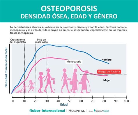 Infografía comparando la densidad ósea normal y la osteoporosis