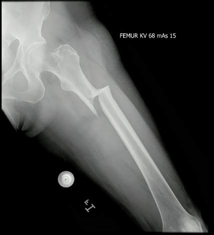Radiografías de fémur izquierdo (proyecciones anteroposterior y lateral) a los 12 meses posquirúrgicos, mostrando formación ósea y alineación del fémur.