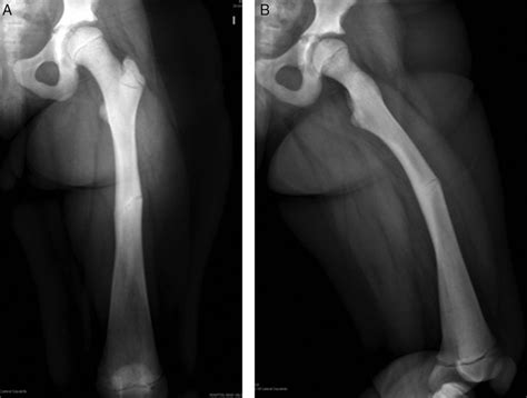 Imágenes clínicas del seguimiento a los 10 meses posquirúrgicos, incluyendo radiografía anteroposterior de fémur izquierdo.