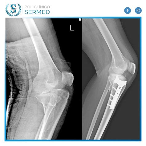 Radiografías de fémur y rodilla izquierdas de seguimiento a los 24 meses posquirúrgicos, evidenciando formación ósea y material de osteosíntesis.