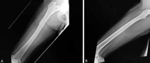 Radiografía de fémur izquierdo (proyección anteroposterior y lateral) a los 13 años posquirúrgicos, mostrando consolidación completa del defecto óseo.