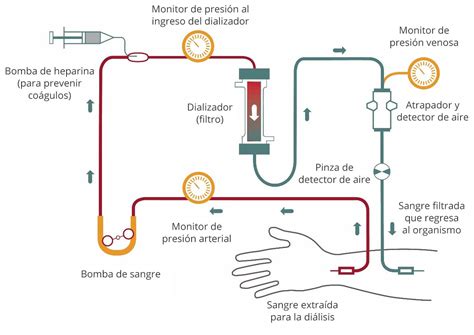 Diagrama del proceso de hemodiálisis mostrando el flujo de sangre y líquido de diálisis a través del dializador.