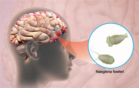 Diagrama que muestra la ruta de infección de Naegleria fowleri desde la nariz hasta el cerebro