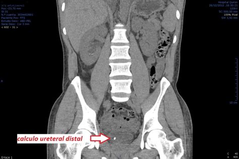 Imagen TAC mostrando litiasis intestinal