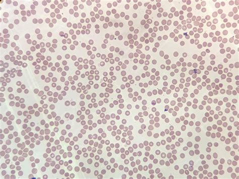 Microscopía de eritrocitos en agua destilada