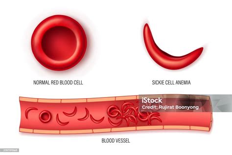 Comparativa microscópica: eritrocitos normales vs. eritrocitos falciformes
