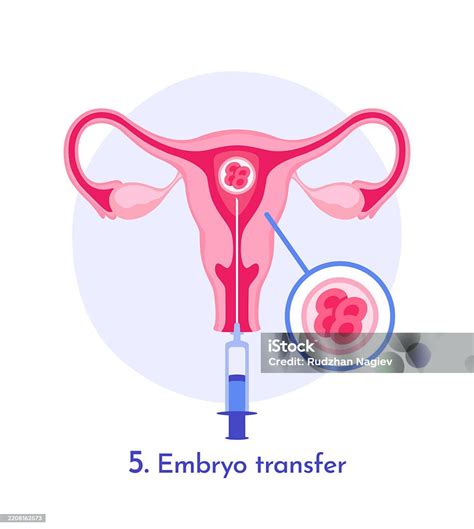 Ilustración del proceso de transferencia embrionaria