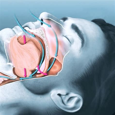 Ilustración de las vías respiratorias colapsadas durante la apnea del sueño