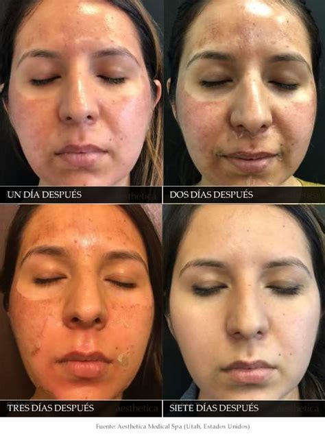 Piel antes y después de un peeling químico