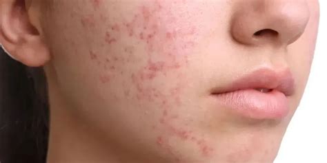 rostro con acné siendo tratado con mascarilla