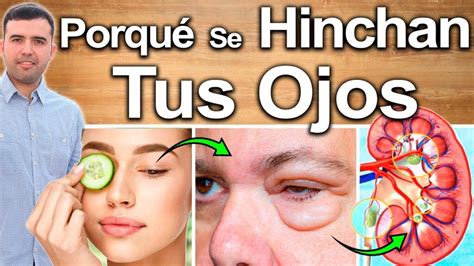 Ilustración de las causas comunes de los ojos hinchados