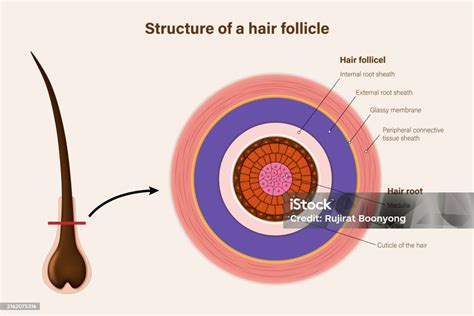 Diagrama de un folículo piloso inflamado y un vello encarnado