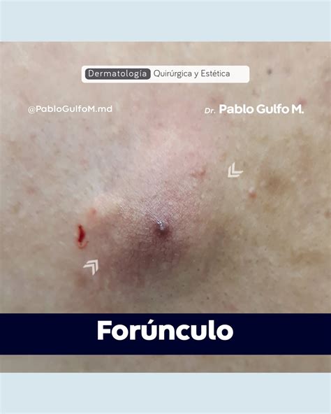 Ilustración de un forúnculo