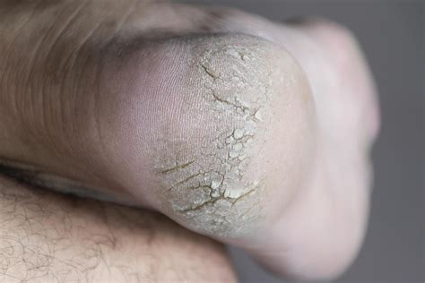 Primeros planos de piel seca con grietas finas